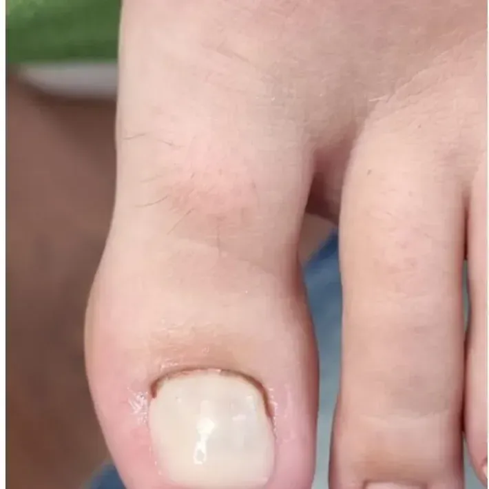 Derselbe Zehennagel nachher: nach der Nagelprothetik gleichmäßig aufgebaut und hell
